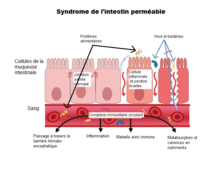 leaky gut